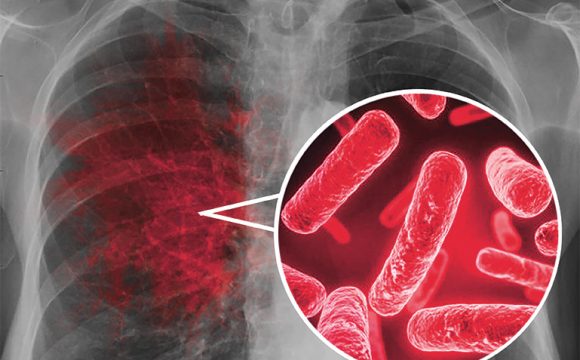 Program pilotażowego leczenia gruźlicy wielolekoopornej w warunkach ambulatoryjnych