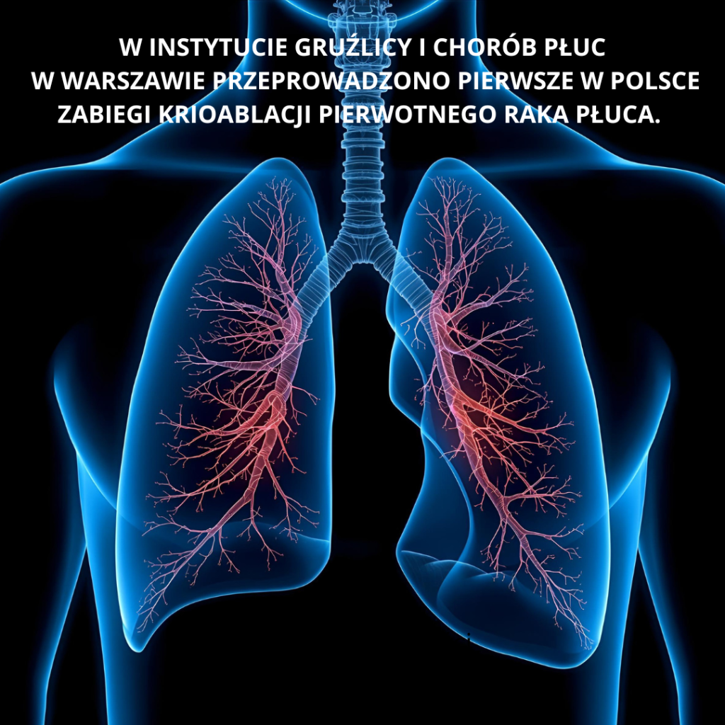Pierwsze w Polsce zabiegi krioablacji pierwotnego raka płuca w Instytucie Gruźlicy i Chorób Płuc